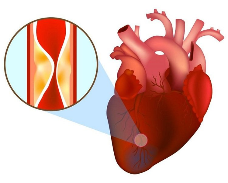 cholesterol-tang-cao-gay-anh-huong-cuc-xau-den-suc-khoe-1