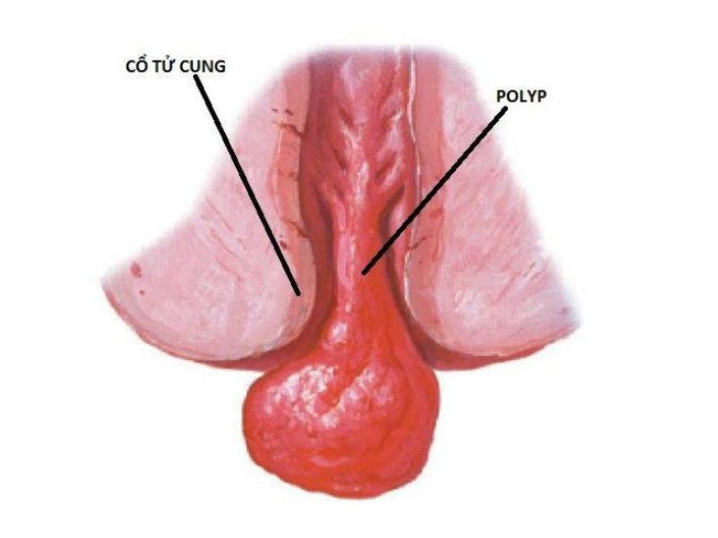 polyp-co-tu-cung-khi-mang-thai-2