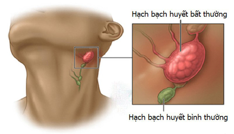 Phương pháp chẩn đoán và xác định viêm hạch góc hàm trái là gì? 
