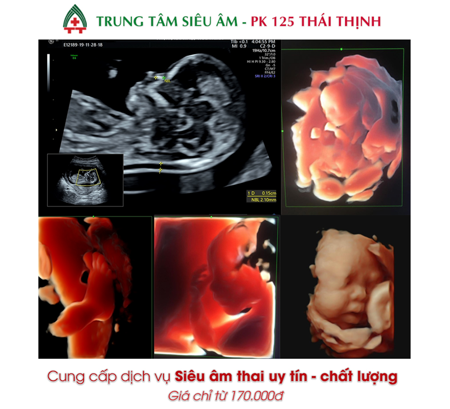 Nhau thai là một trong những giai đoạn quan trọng trong cuộc sống thai nhi. Theo dõi sự phát triển và sức khỏe của nhau thai của bạn rất quan trọng để đảm bảo thai nhi được phát triển tối đa. Nếu bạn muốn biết thêm về nhau thai và những vấn đề liên quan đến nó, hãy xem hình ảnh liên quan đến nhau thai.