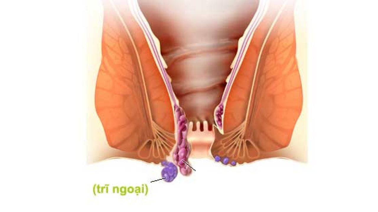 4. Lưu ý khi sử dụng thuốc chữa trĩ ngoại