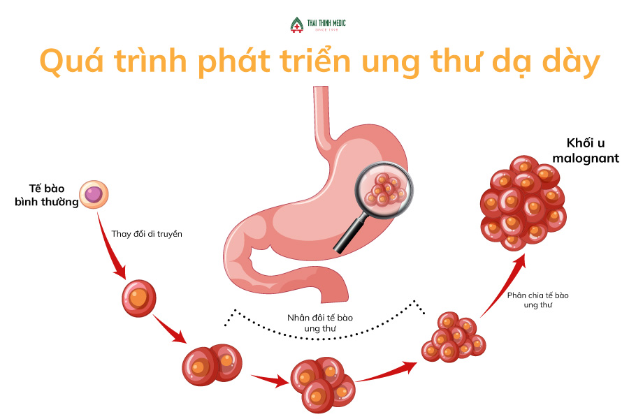 Làm thế nào để phòng ngừa ung thư dạ dày tế bào nhẫn?
